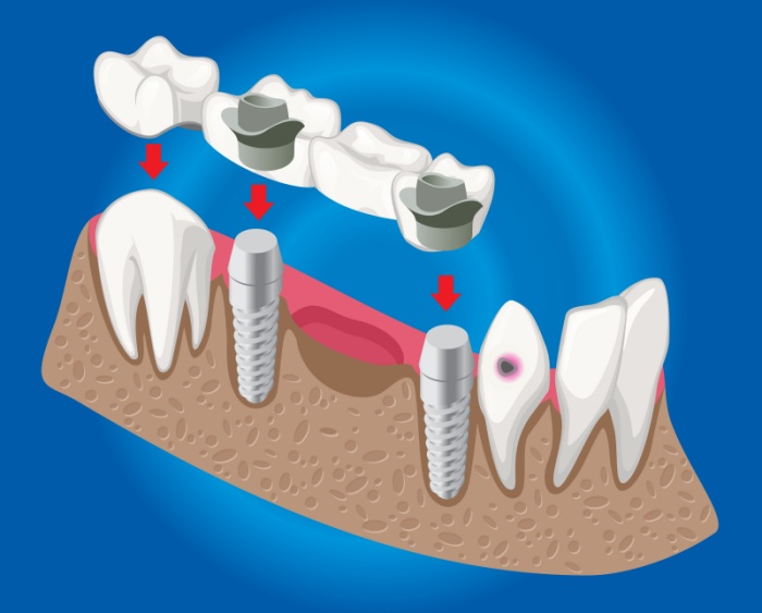 Punte pe implanturi dentare Clinica SyroDent Bucuresti