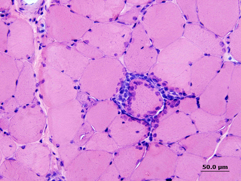 Células inflamatórias ao redor da miofibra não necrótica na MCI. © 2021 UpToDate , Inc. e / ou suas afiliadas. 