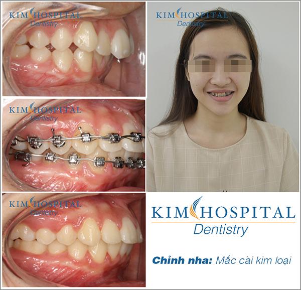 niềng răng hô hàm trên tại nha khoa Kim Dentistry