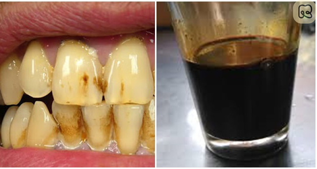 Những nguyên nhân khiến răng ố vàng thường gặp