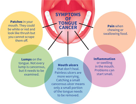 tongue cancer.jpg