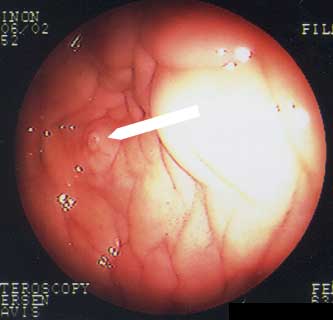Hysteroscopic views of the uterotubal junction (UTJ) of mares during estrus. Arrows indicate the location of the UTJ.