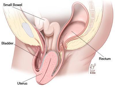 https://my.clevelandclinic.org/-/scassets/images/org/obgyn/obgyn-uterine-prolapse4.ashx?la=en&hash=FC1562A6BABF88757C10CE4596844F9B4511D9C6