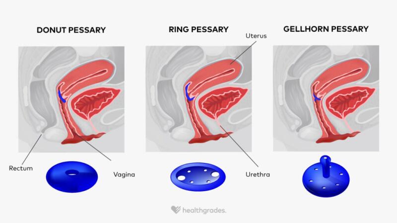 How A Pessary Changed My Life