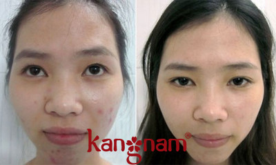 Viên uống trị mụn Murad review