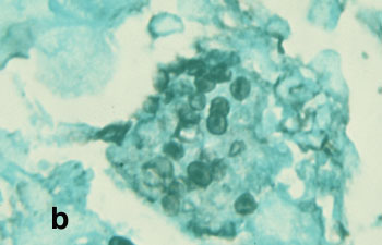 Pneumocystis carinii en el pulmon de un animal con PSCID.