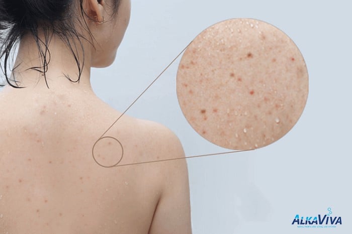 BẠN CÓ BIẾT VÒI SEN DƯỠNG ẨM GIÚP GIẢM MỤN LƯNG