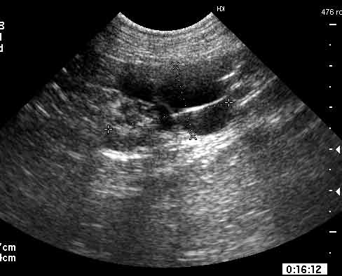Incidental, spontaneous cystic ovary