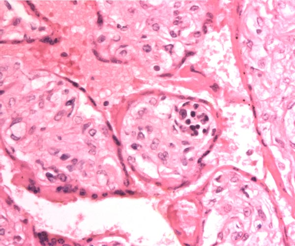 Immature placenta of stillborn fetus with 39 g placenta. Villi are larger than at term and contain foci of hematopoiesis (dark elements). Rare cytotrophoblastic cells can be identified