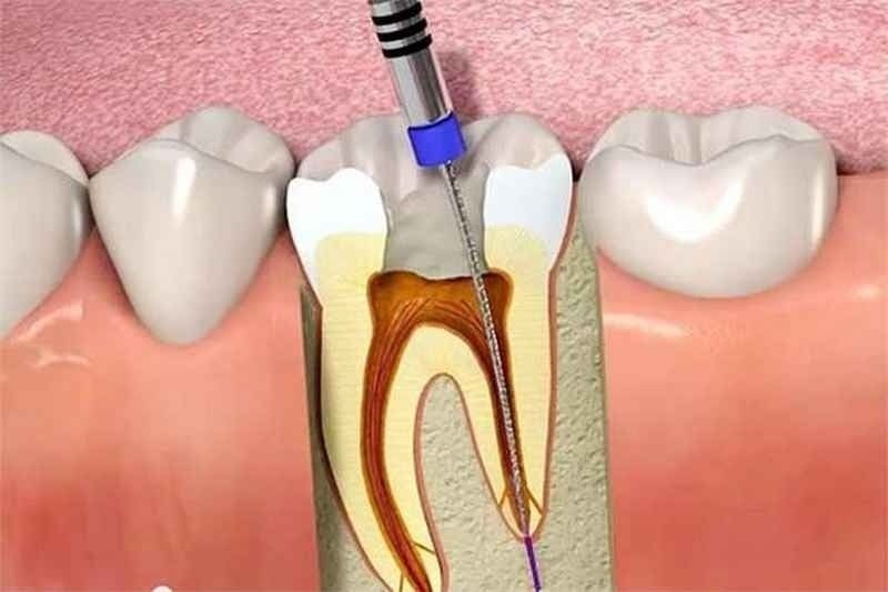Bọc răng sứ là phương pháp bảo vệ răng thật tối ưu nhất