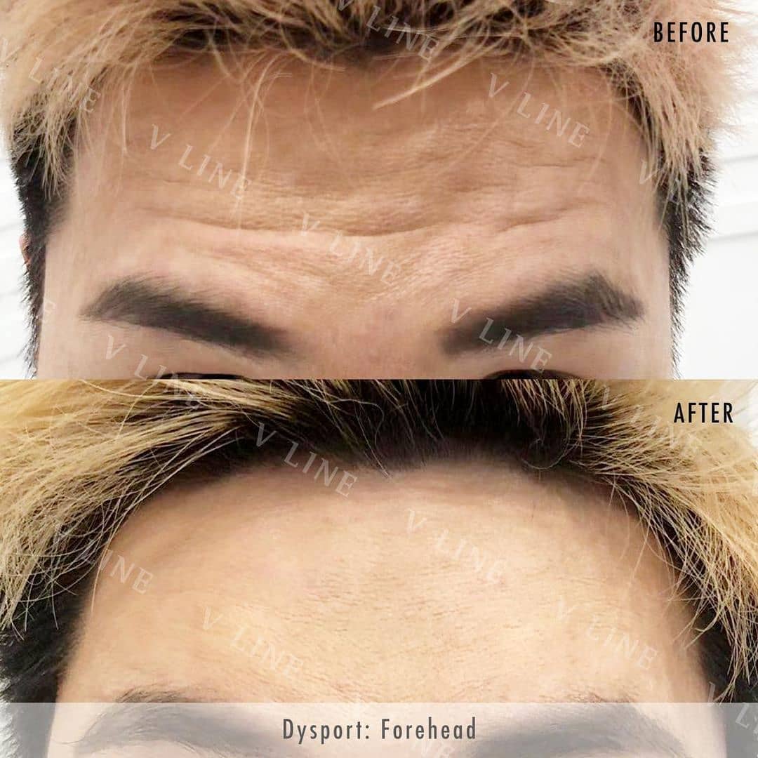 Dysport before and after treatment photos for a client at our Toronto cosmetic clinic