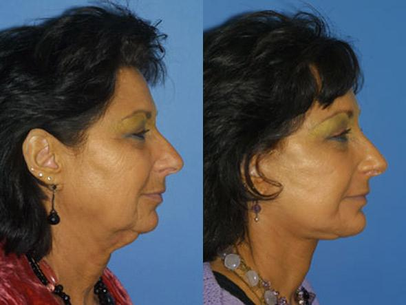 surgical solutions to reduce wrinkles before and after