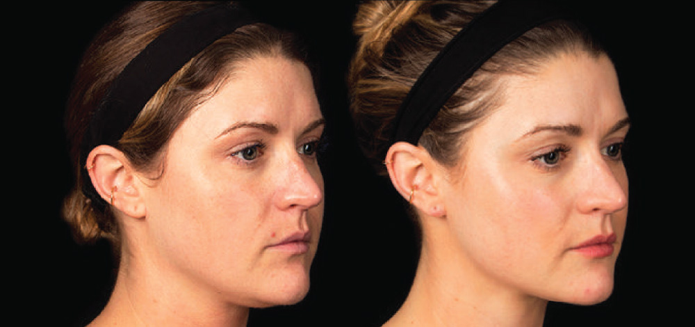 PRP is Effective On Acne and Scars.  
