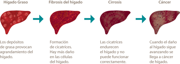 fundhepa-progreso-daño-hepático