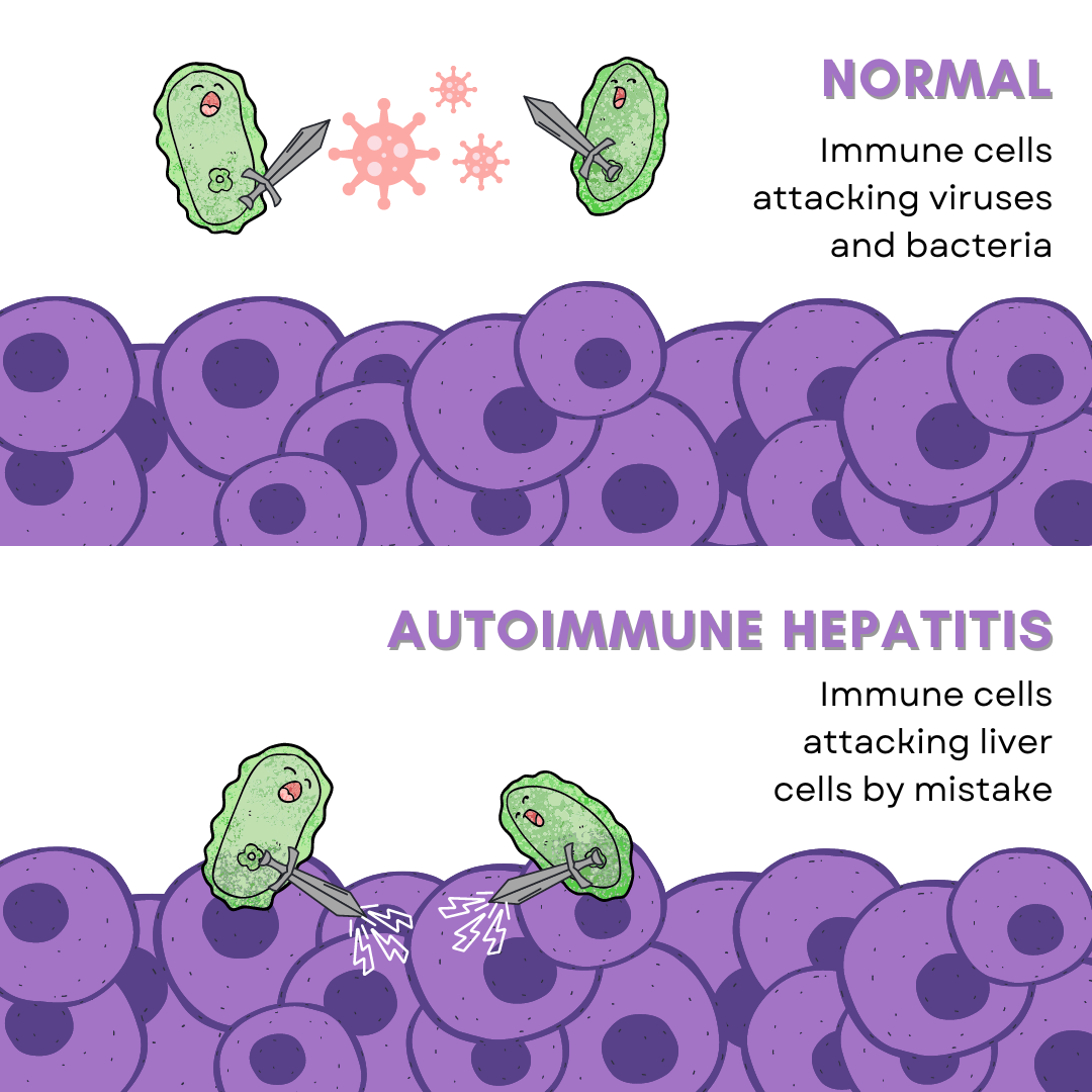 Is Gilbert's Syndrome An Autoimmune Disease: Autoimmune Hepatitis