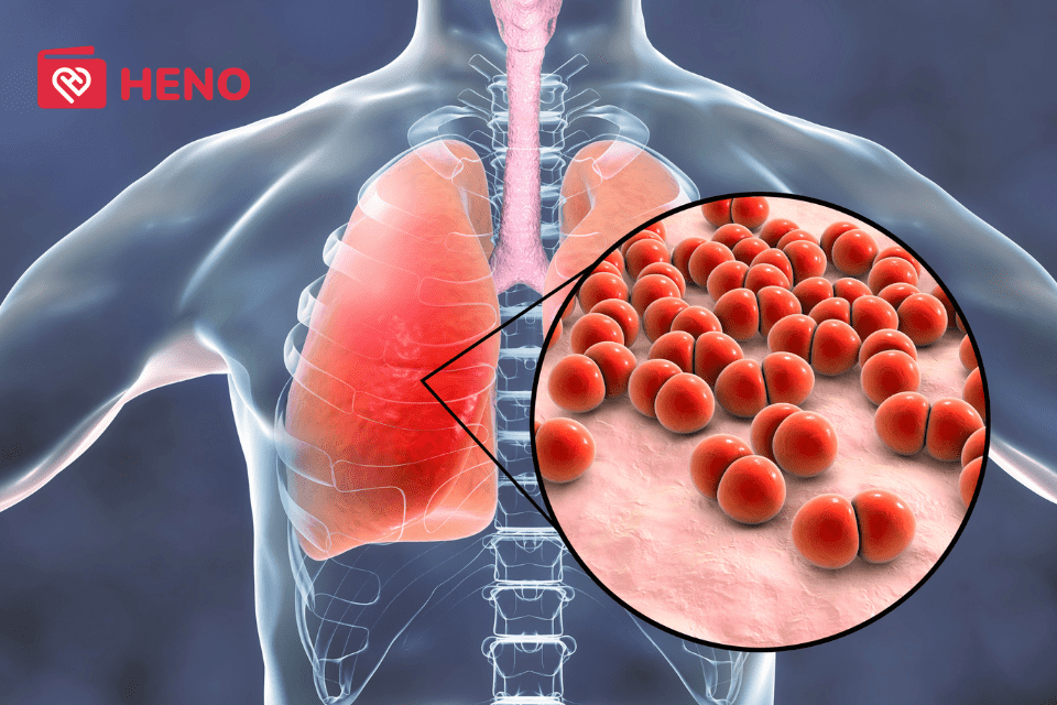 Viêm phổi cấp là một bệnh lý viêm nhiễm của phổi
