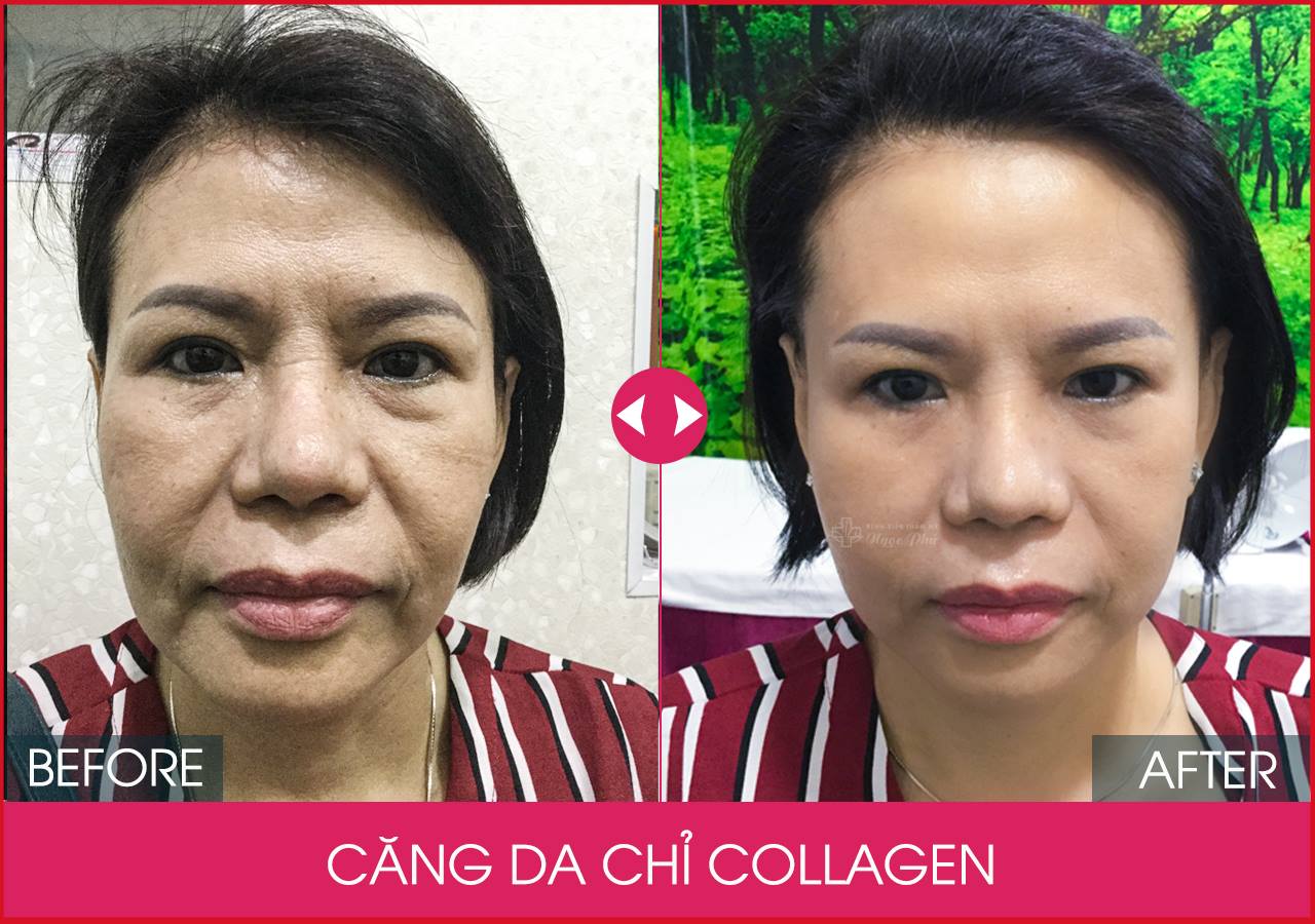 Căng da mặt bằng chỉ collagen giữ được bao lâu là câu hỏi được nhiều chị em quan tâm nhất.