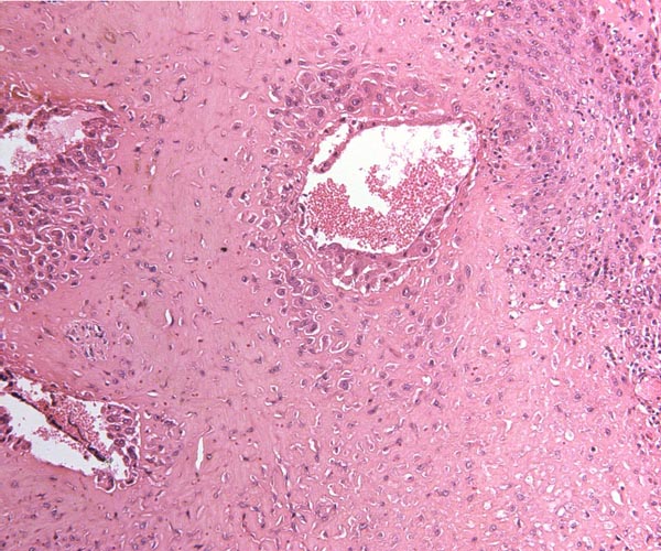 Maternal spiral arteriole in the decidual floor of a mature Patas monkey placenta. Note that the muscular wall is partially replaced by extravillous trophoblast
