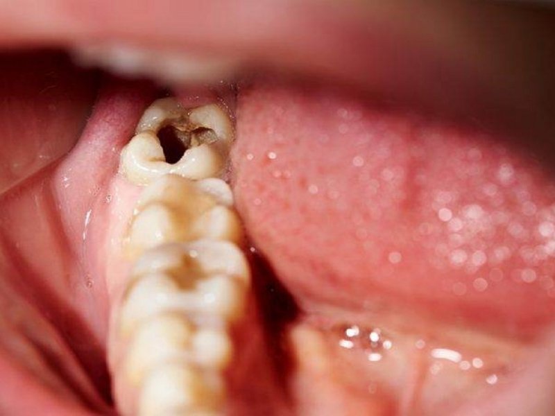 Mô cứng của răng bị tổn thương nghiêm trọng, lỗ sâu lớn 