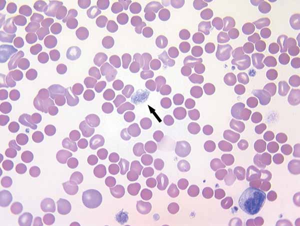 Canine blood smear in immune-mediated hemolytic anemia and thrombocytopenia. Platelet numbers are reduced and a large blue granular cell (arrow) is a macroplatelet suggesting increased platelet turnover in this thrombocytopenic situation. Small dark red blood cells without central pallor throughout field are spherocytes (50x).