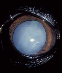 Cataracts