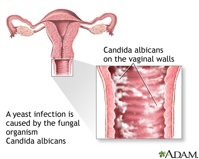 What does a yeast infection look like?