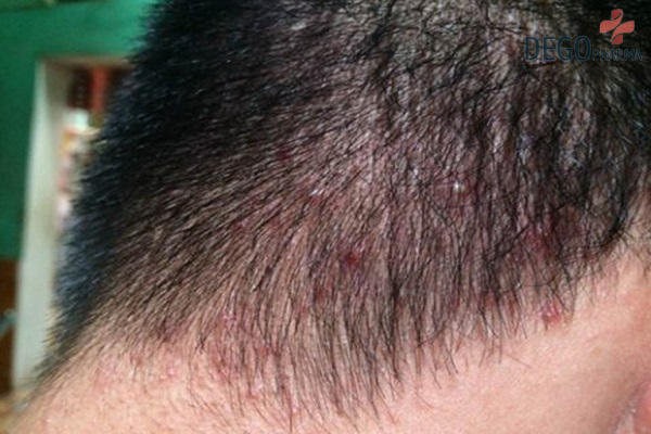 Nấm da đầu biểu hiện giai đoạn thứ hai là ngứa ngáy, xuất hiện mụn da đầu