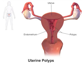 What are uterine polyps