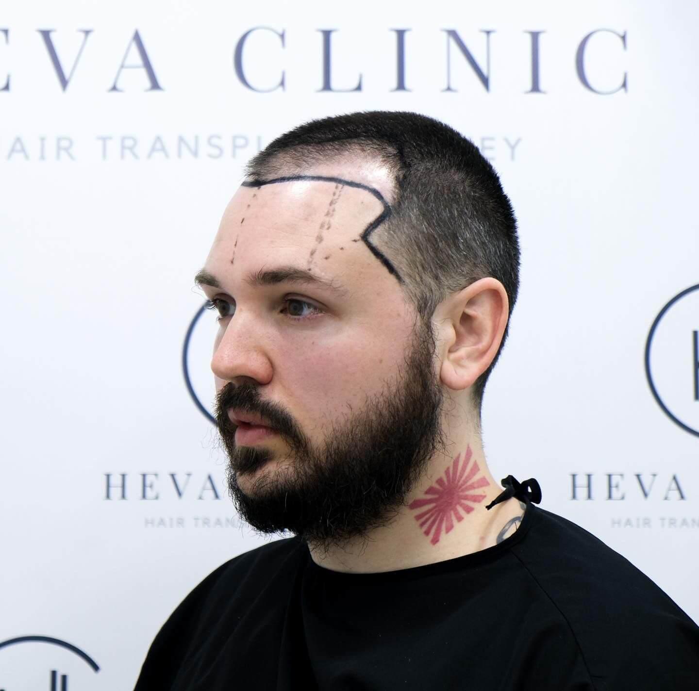 Do hair transplants work Types side effects and recovery