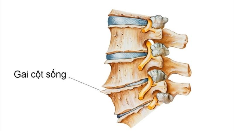 Gai cột sống gây đau thắt lưng khi nằm ngửa