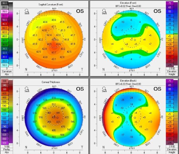 Corneal topography showed a central-inferior steepened zone... | Download  Scientific Diagram