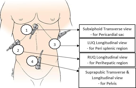 FAST (Focused Assessment with Sonography for Trauma)  