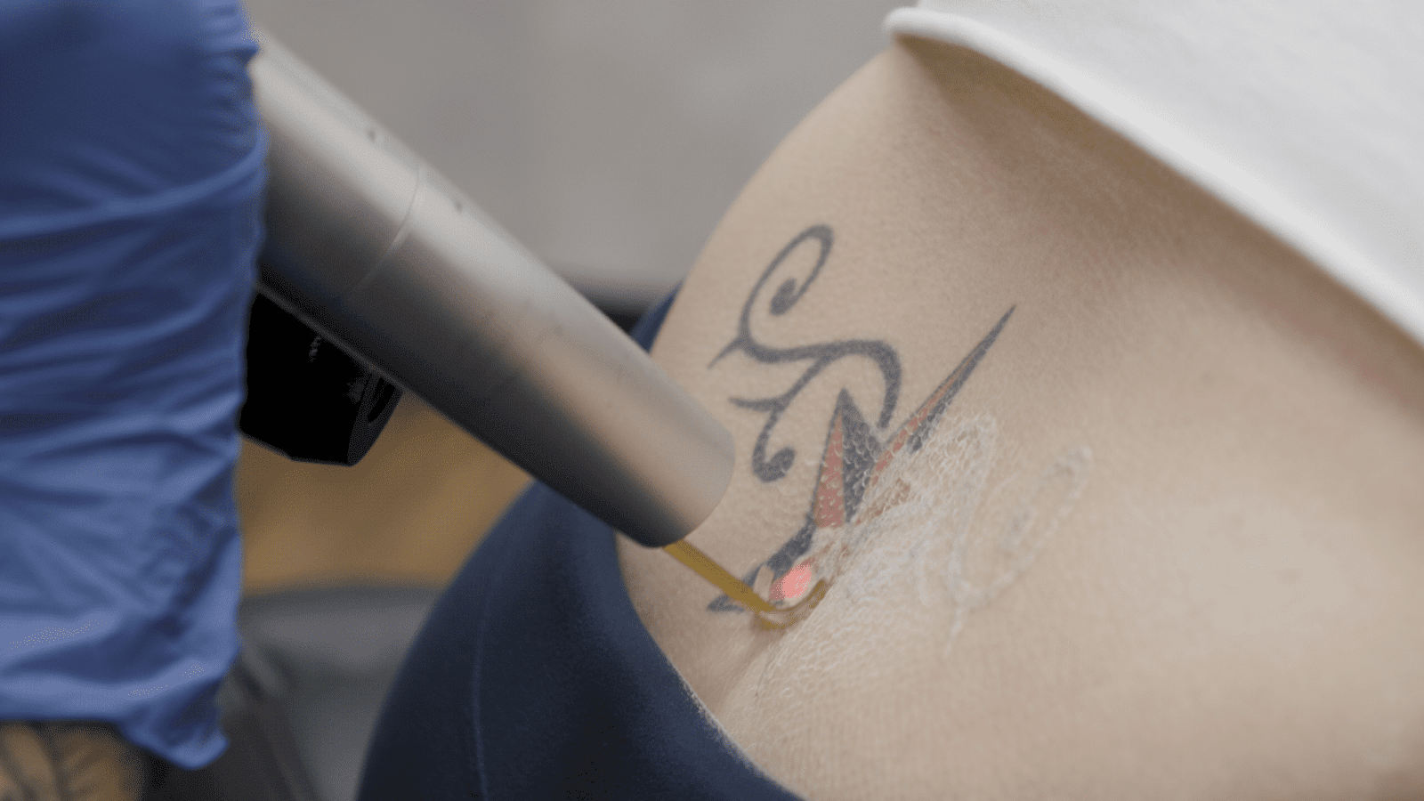 Picosure Tattoo Removal vs Picoway Tattoo Removal | Removery