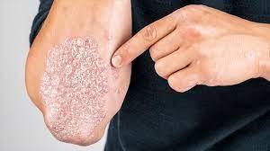 What is Psoriasis? Dermatologist Explains Types, Treatments, How to Cope