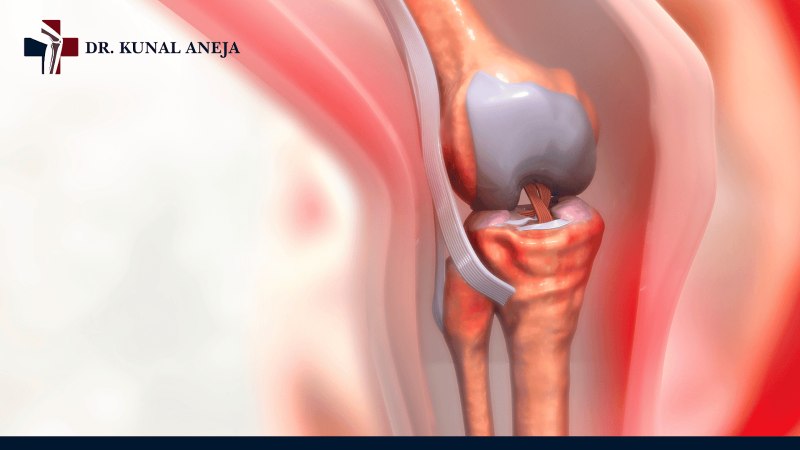 Knee Replacement in Delhi | Surgery Details & Recovery