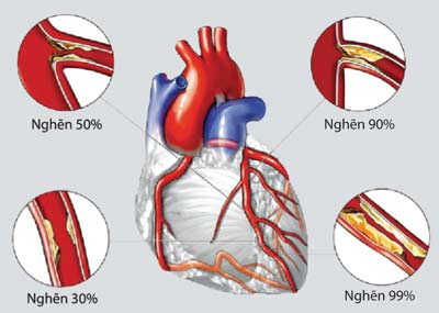 Cao huyết áp ảnh hưởng xấu tới tim