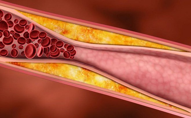 Thừa nhiều kẽm làm giảm HDL cholesterol, dễ gây xơ vữa động mạch