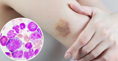 Leucemia mieloide aguda