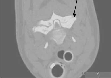 Extradural compression: severe stenosis at the level of the C4-5 facet joint in a 7-year-old, FS Basenji with unremitting cervical pain and mild neurologic dysfunction