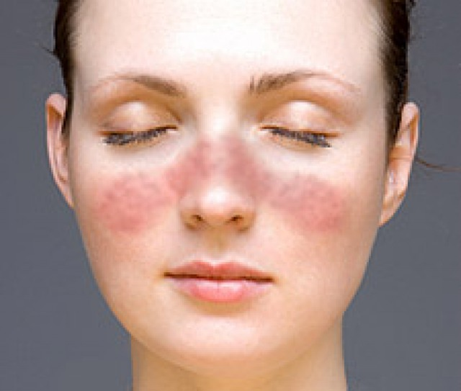 Lupus' symptom, butterfly rash