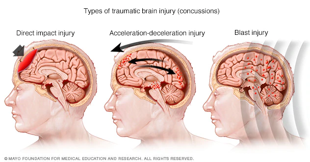 What Is A Concussion Agape Physical Therapy 