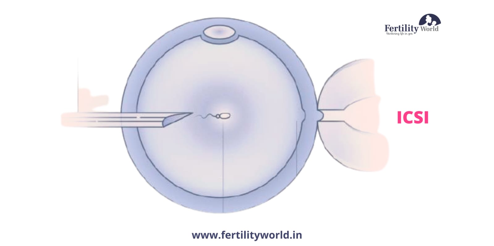 Cost of Intracytoplasmic sperm injection (ICSI) in India