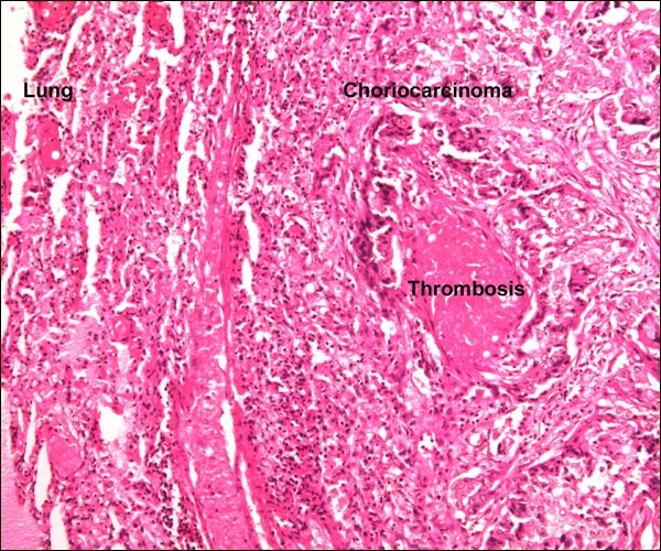 Post partum choriocarcinoma in uterus and metastasis to lung in rhesus monkey