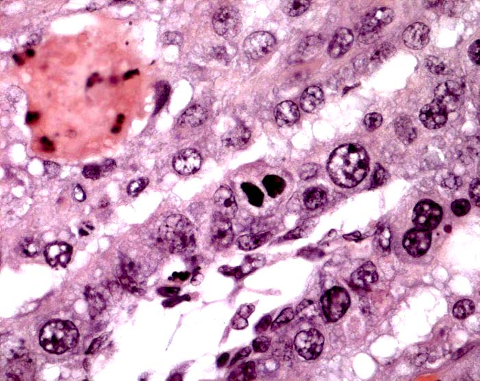 Maternal tissue above; villus below with binucleate cell and one giant trophoblastic nucleus.