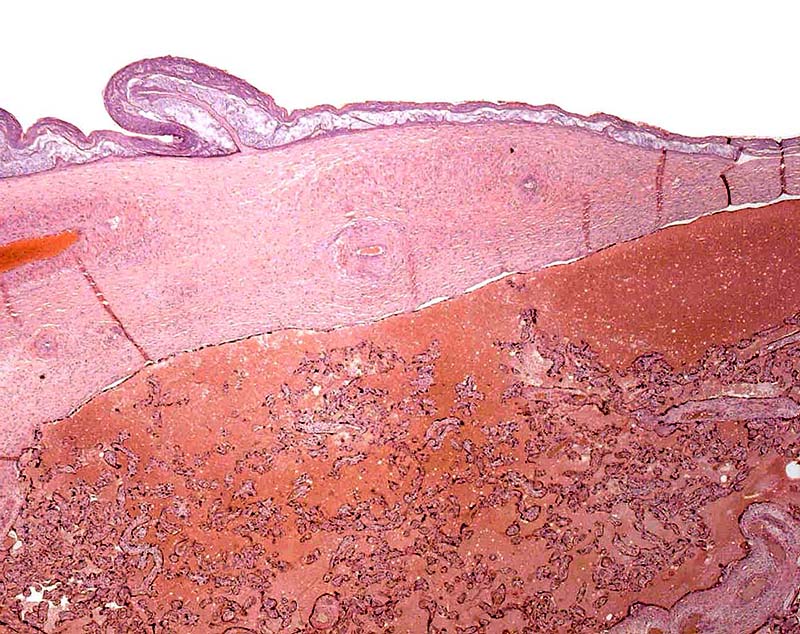 Low power view of the fetal surface with amnion partially detached and fetal vessel in the chorion. 