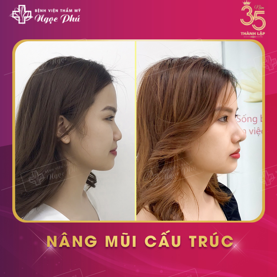 Nâng mũi Hàn Quốc đẹp tự nhiên, mềm mại