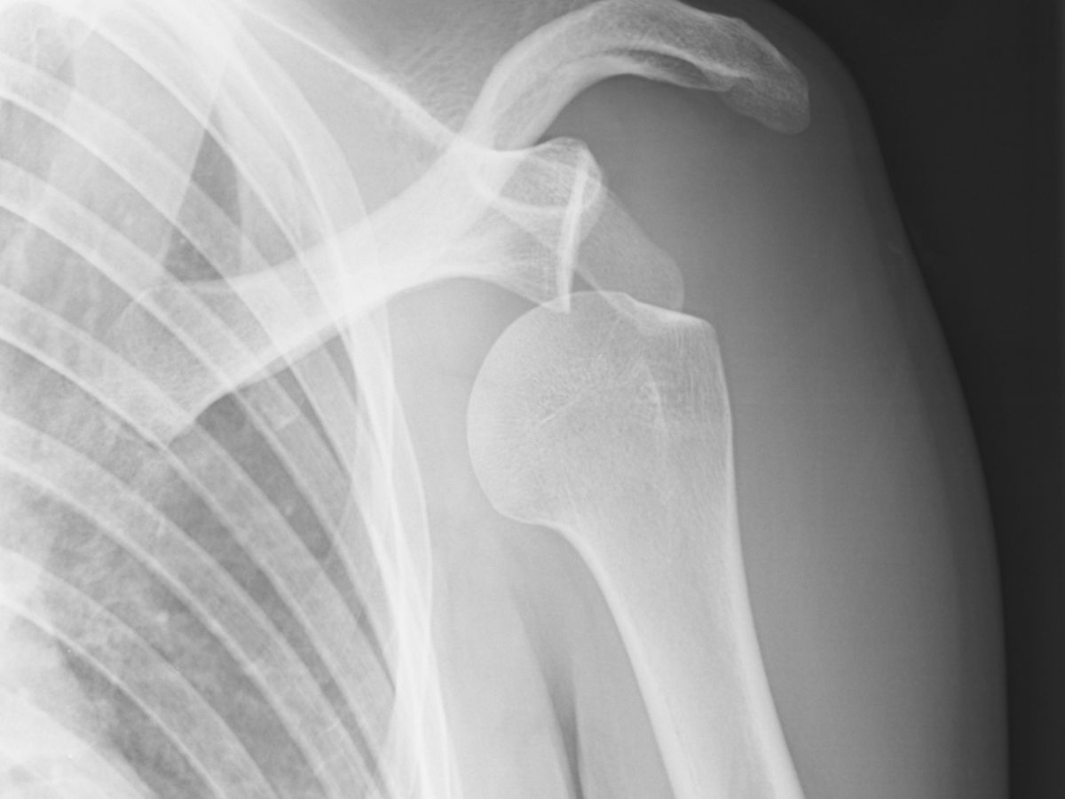 X-Ray of Dislocated Shoulder