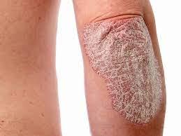 Psoriasis: Everything You Need to Know About This Chronic Skin Condition -  Apex Dermatology & Skin Surgery Center - Cleveland, OH Dermatology