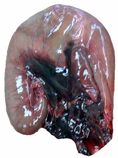 Pregnant uterus of the specimen described here also showing the abdominal hemorrhage