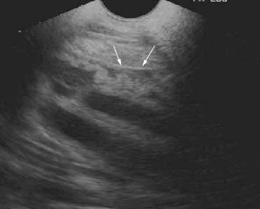 Transabdominal and transrectal ultrasonography of the placenta in a mare during 9th month of gestation. The arrow points to the area of placental separation.
